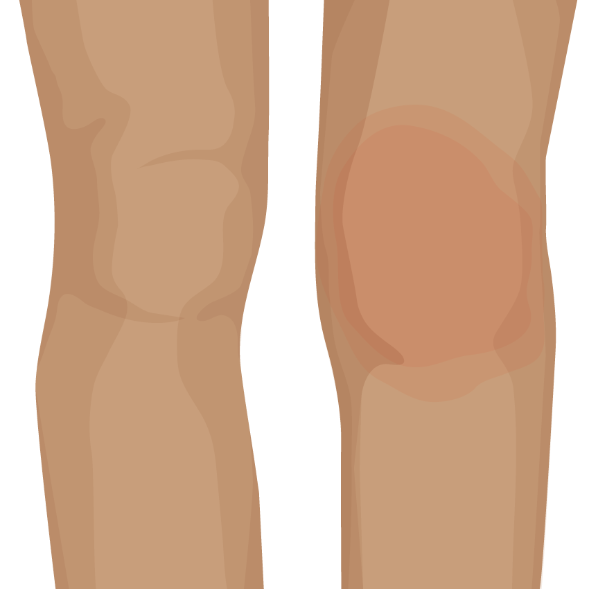 Image of two knee joints, one is red and swollen